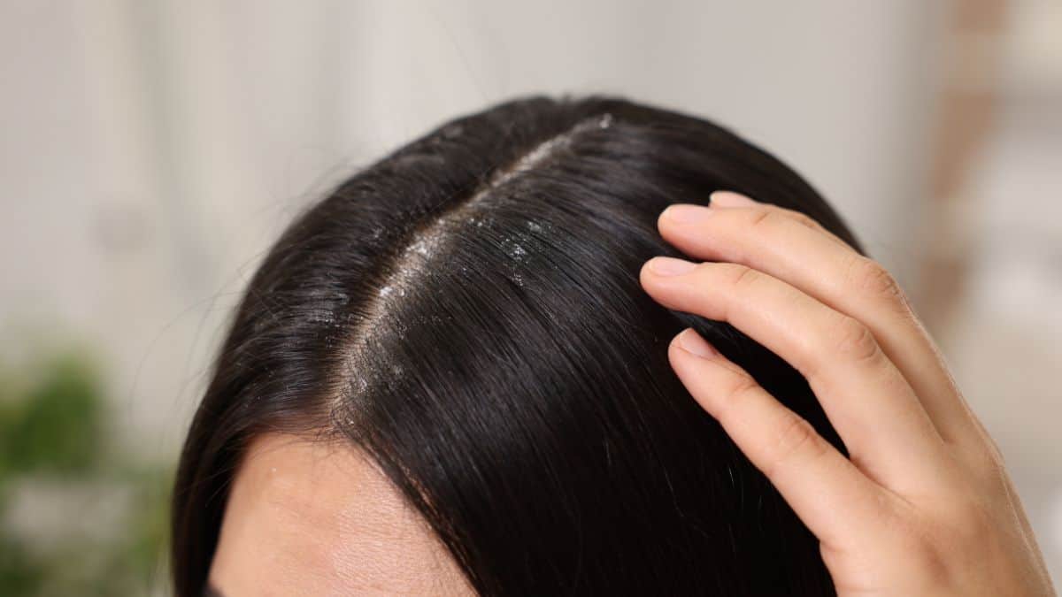 Woman's scalp with dandruff.